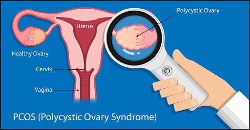 POLYCYSTIC OVARY SYNDROME(PCOS)